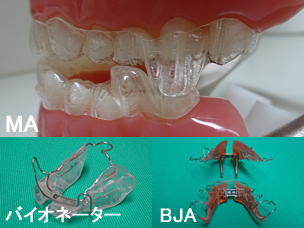 10代の矯正治療